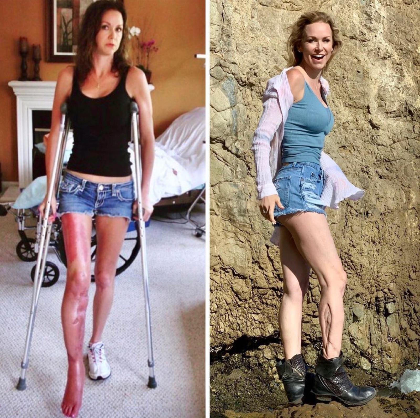 Amberly Lago before and after: on crutches during her recovery, then healed and thriving